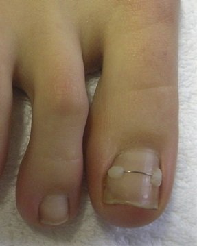 nagelbeugel 2